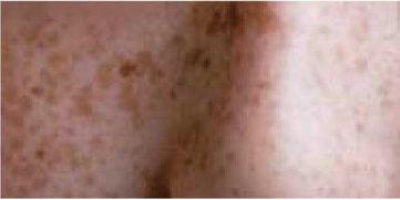 面斑图片,探寻肌肤瑕疵的成因与应对之道